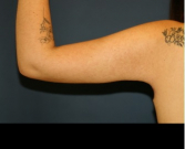 Feel Beautiful - Arm Reduction 202 - After Photo